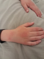 Ds sore red/swollen hands