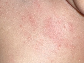 IScarlet fever or heat rash