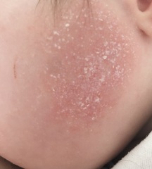 Baby's eczema weeping help pls