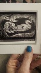Gender prediction-nub theory