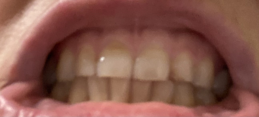 I'm about to cry about my teeth