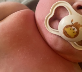 Awful dribble rash pics