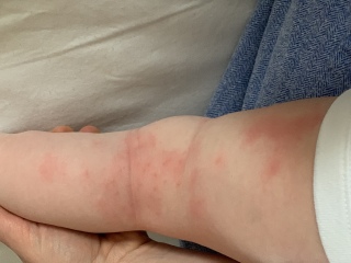 Baby being bitten!!! By what?