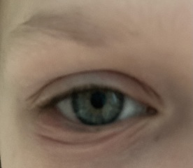 Why has my 7 year old got bags under their eyes? (pics attached)
