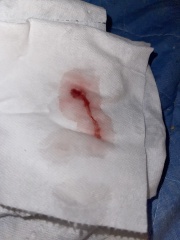 Tissue passed during period includes pic