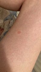 Weird rash and a mark. I'm PREGNANT and worrying.