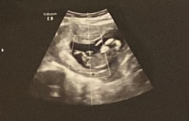 Has anyone been told the gender at 12 week scan?