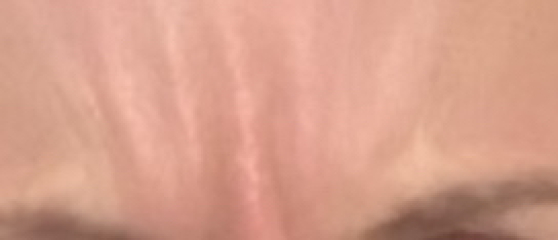 Botox before and after