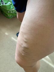 Depressed at the state of my leg