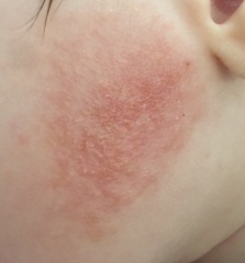 Baby's eczema weeping help pls