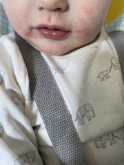 What could be causing this rash on my baby's face??