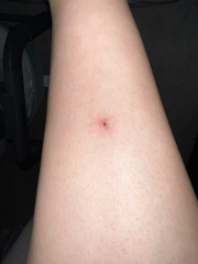 Red itchy lump