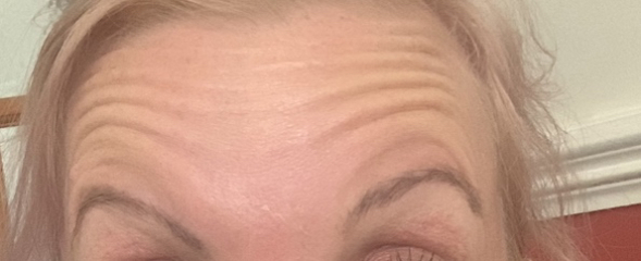 Botox before and after