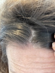 Is this dandruff?! 