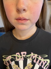 Red cheeks- 11 year old DD