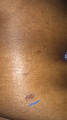 Mark on boob - worried - anyone know what it can be ?