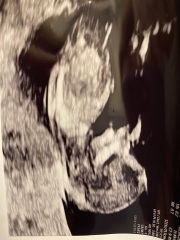 12 week scan, nub/skull guesses?