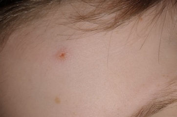 Chicken pox? 
