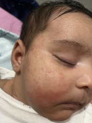 Baby eczema 