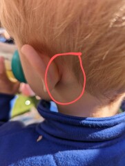 Lumps on sons neck