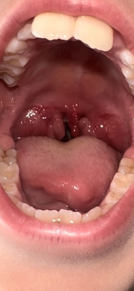 7 year old with tonsillitis, wondering whether to see OOH GP