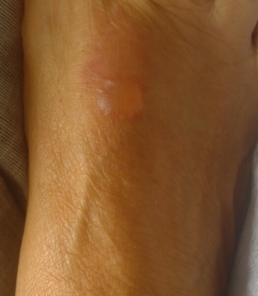 Sunburn blister on foot but need to wear shoes. Pic attached