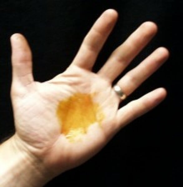 To think that this is jaundice in eye? Photo attached