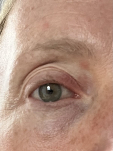 Any idea why my eyelid is doing this?