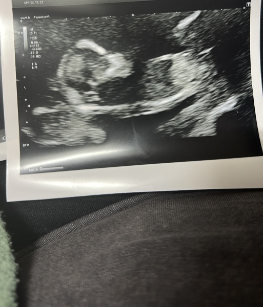 Nub/Skull Theory! Girl or Boy? 