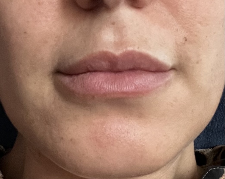 Should I let my 17 year old get filler?