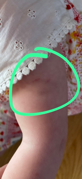Does this look like a bite on child's arm ?