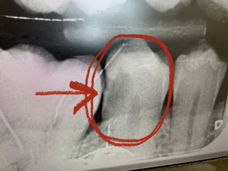 For wondering if I really need a filling? Any dentists around??