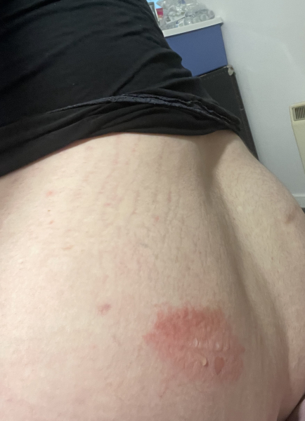 Does this really need A&E?  (Burn - photo warning) 