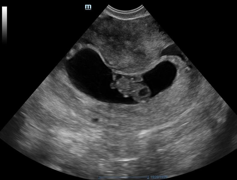 First cycle - IVF / ICSI - Day 4 