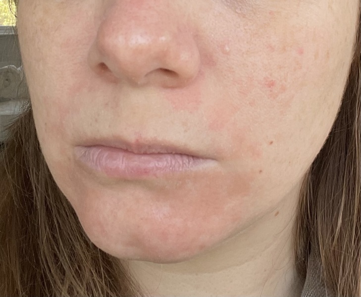 Tret skin issues 