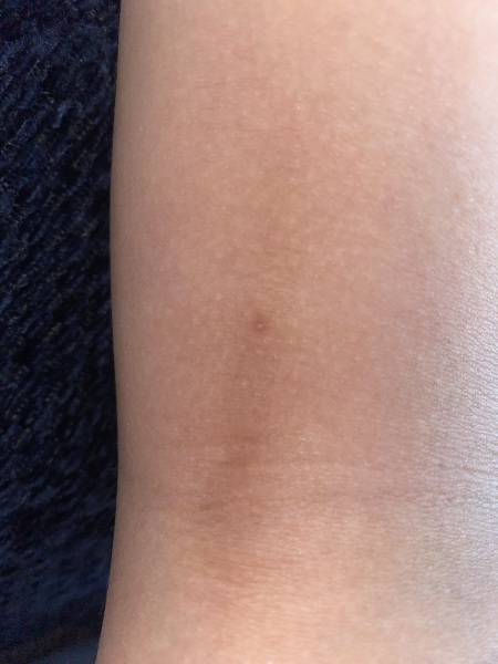 Is this chickenpox 
