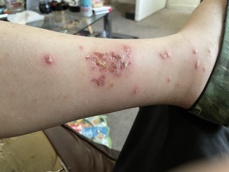 Beautiful infection ( gone now but I still keep the photos!)
