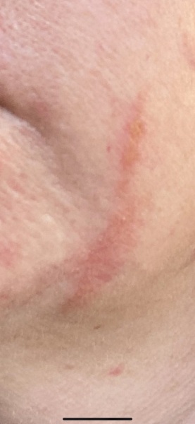 Rash on face