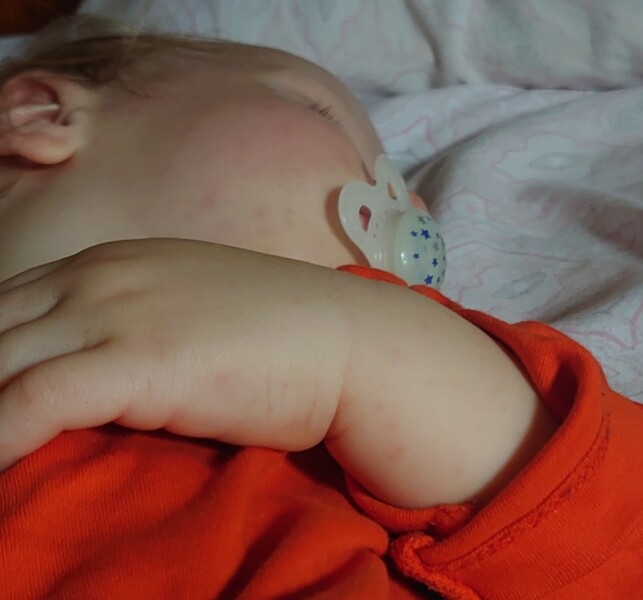 Start of chickenpox? 