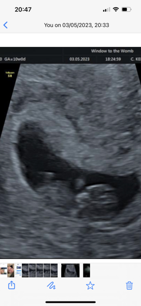 Ivf pregnancy - first trimester