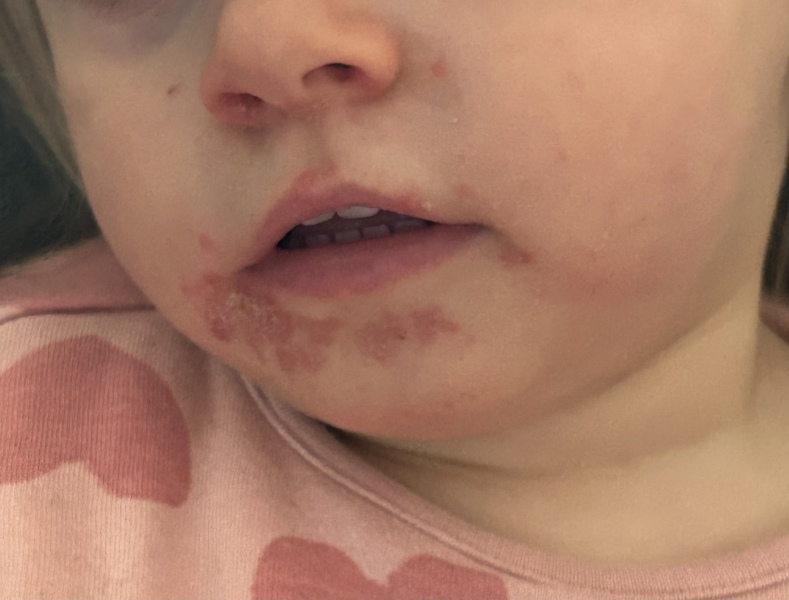 Rash