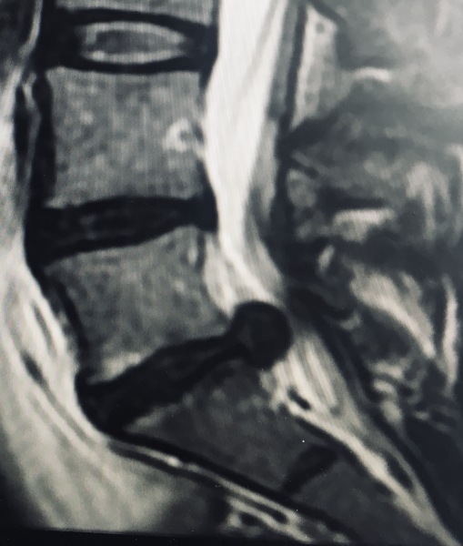 18-year-old DS's excruciating, years-long sciatica – need hope