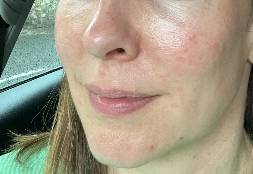 Skin has gone to hell! Please help! 