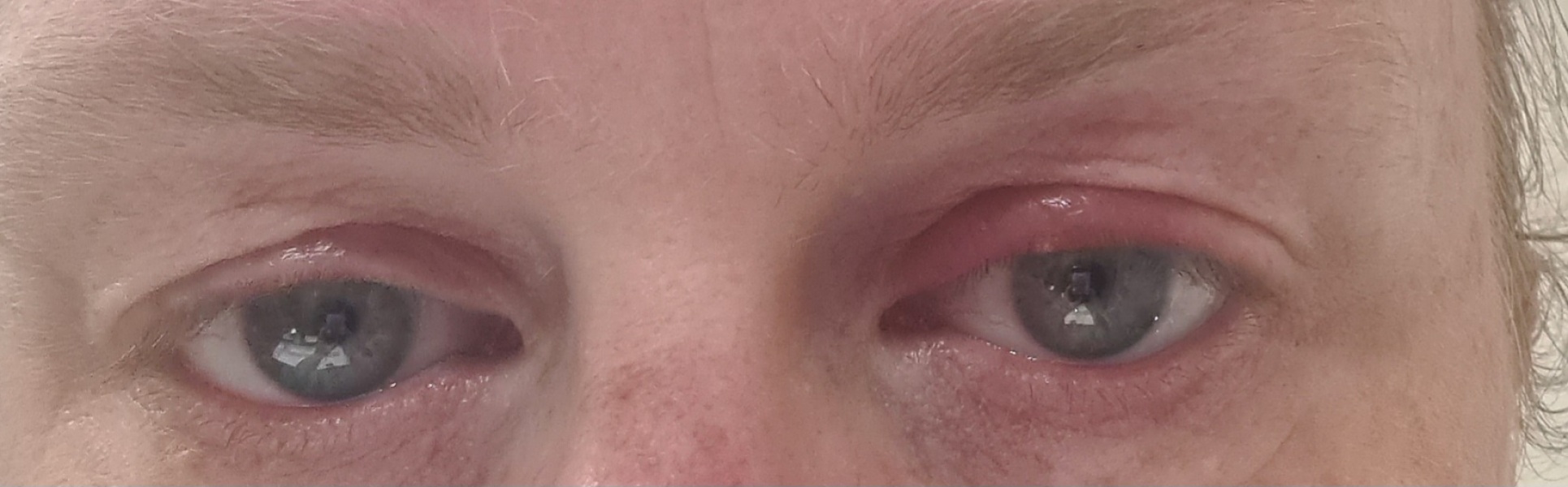 My eyelid is inflamed 