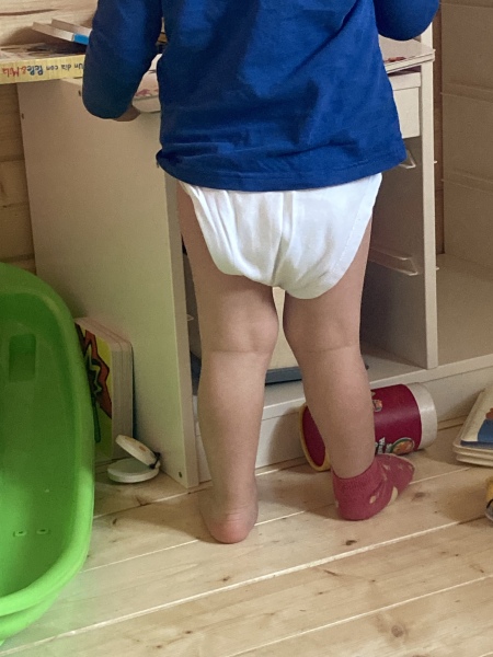 Genu valgum - 2yo?