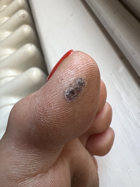 Verrucas - advice needed