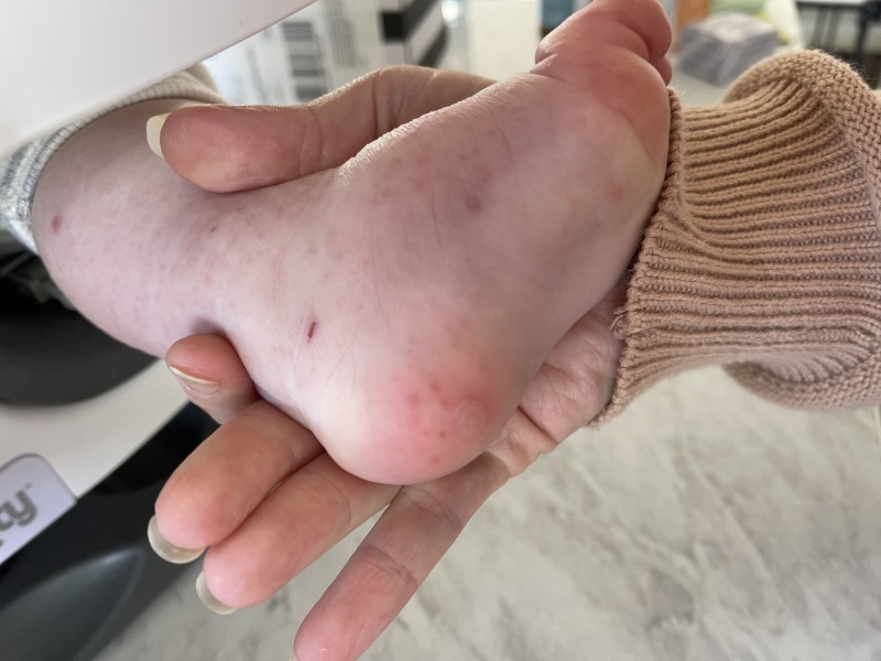 Chicken Pox or HFMD