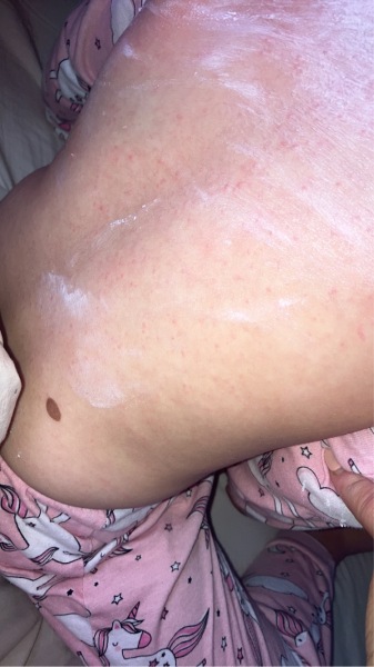 What is this rash 