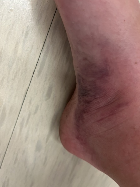 Has anyone ever had DVT?