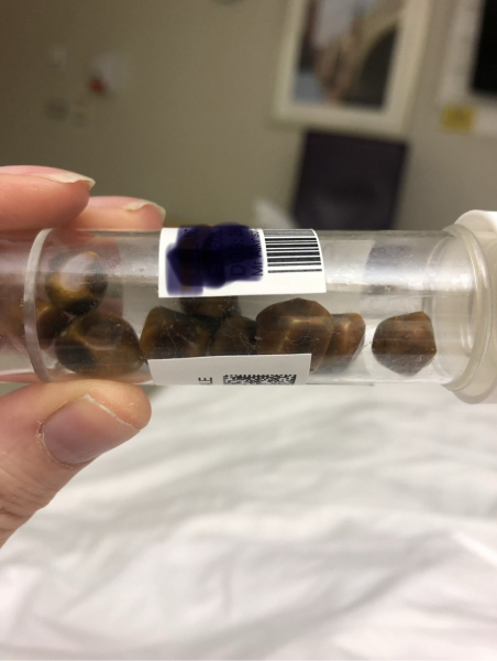 Gallstones 